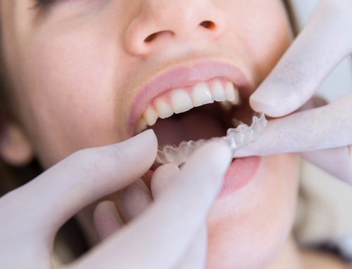 Ortodoncia o cómo no renunciar a la sonrisa perfecta
