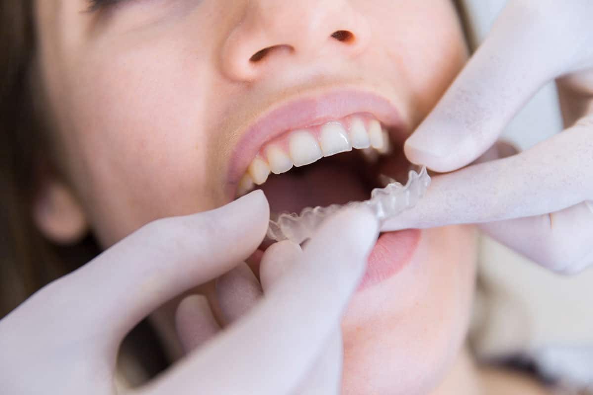 ¿Cuándo aplicar un tratamiento de ortodoncia?