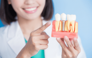 Implantes dentales y las dudas más frecuentes