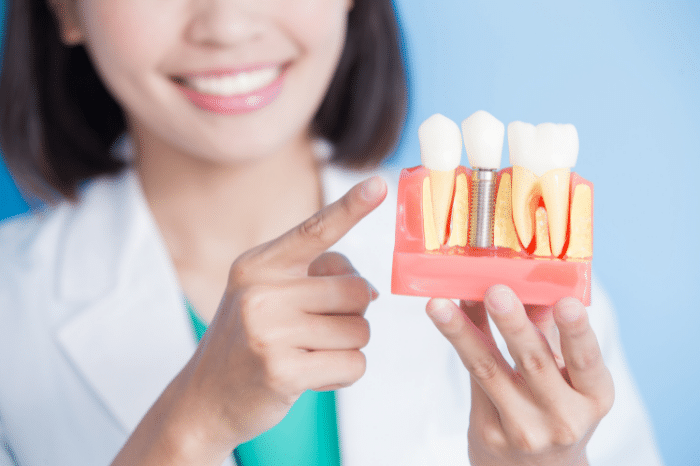 Implantes dentales y las dudas más frecuentes