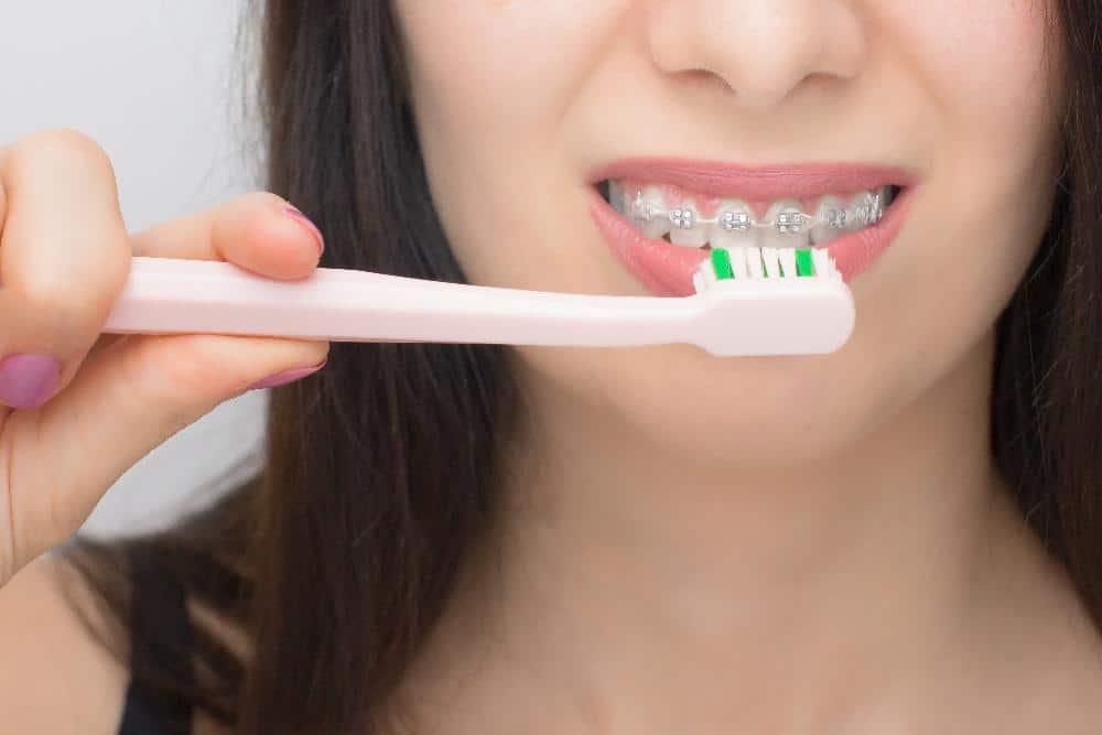 Cómo limpiar los brackets en los distintos tipos de ortodoncia