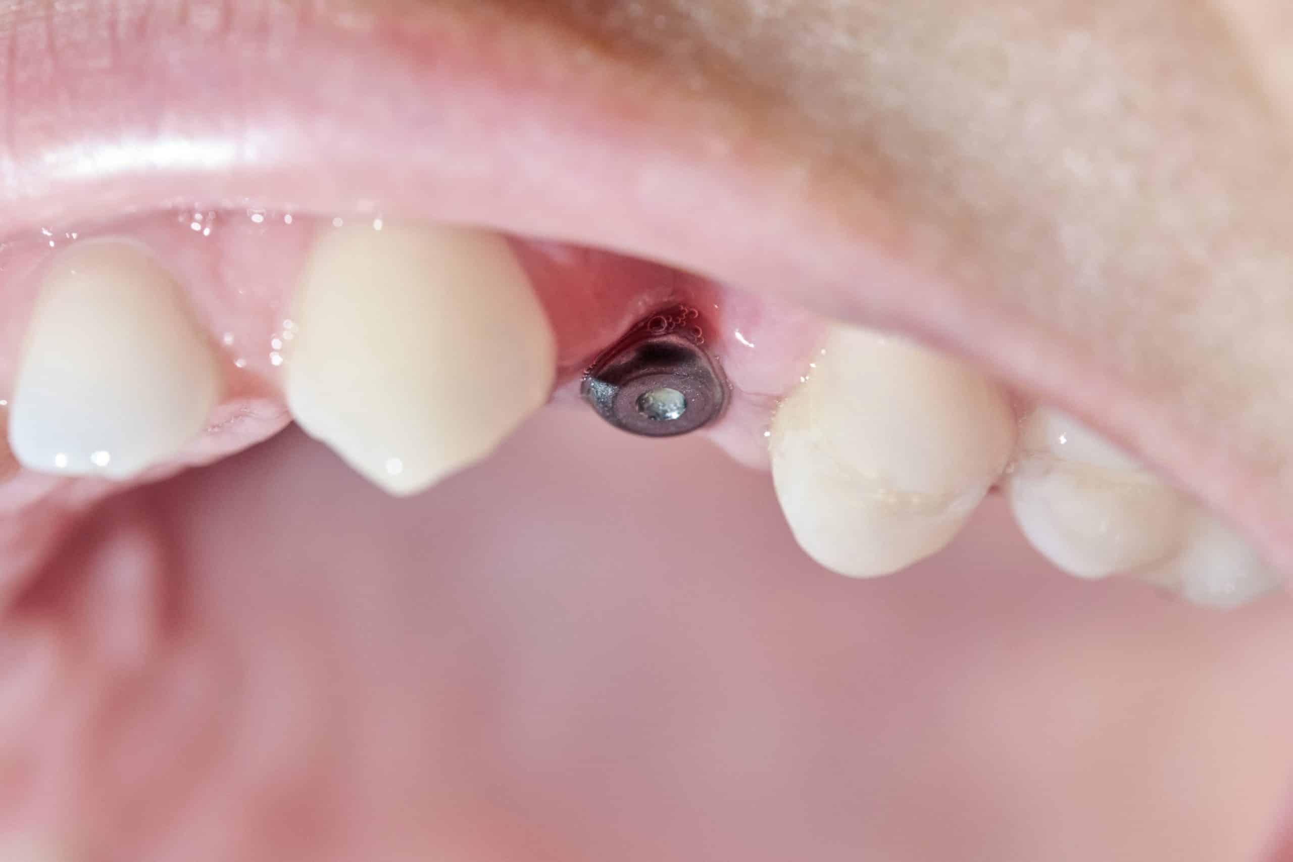 Síntomas de rechazo de un implante dental