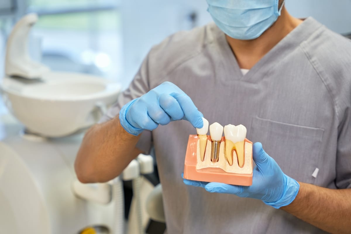 Cómo saber cuántos implantes dentales necesitas
