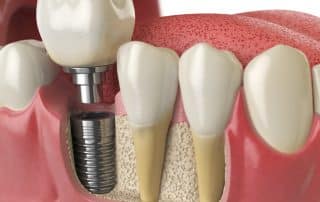 Osteointegración de los implantes dentales: ¿en qué consiste?