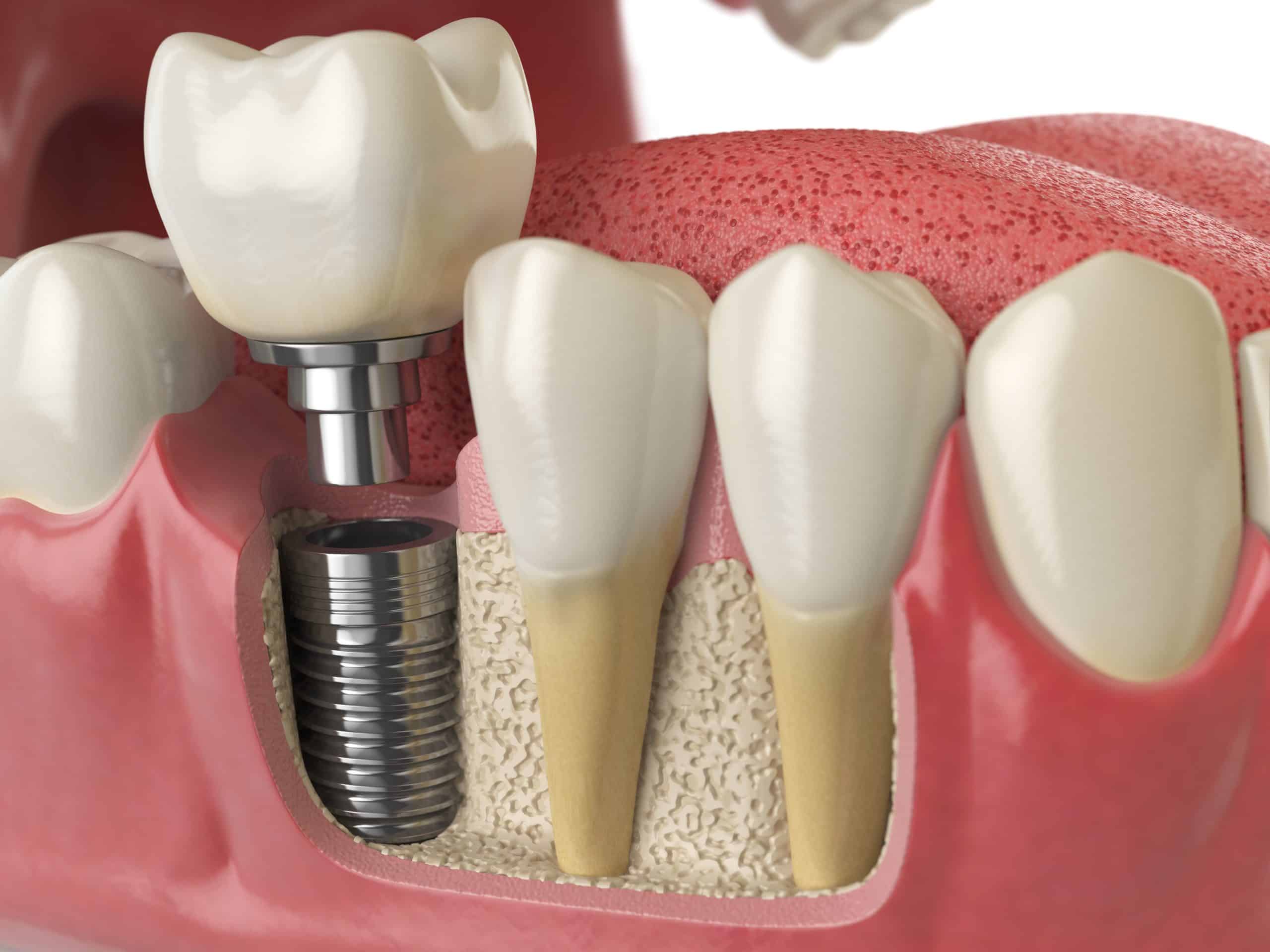 Osteointegración de los implantes dentales: ¿en qué consiste?