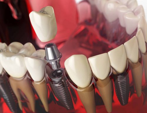 Cómo saber cuántos implantes dentales necesitas