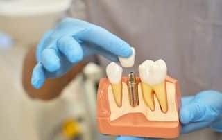 Diferencias entre implantes dentales y puente dental
