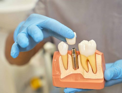 Diferencias entre implantes dentales y puente dental