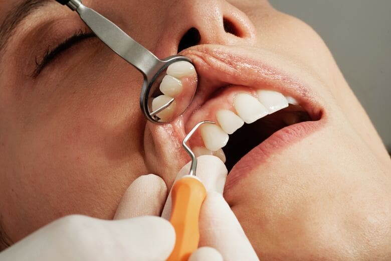 implantes dentales sin cirugia
