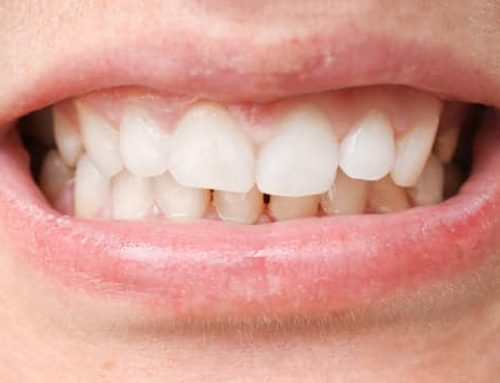 Maloclusión dental: qué es, causas, y cómo se corrige