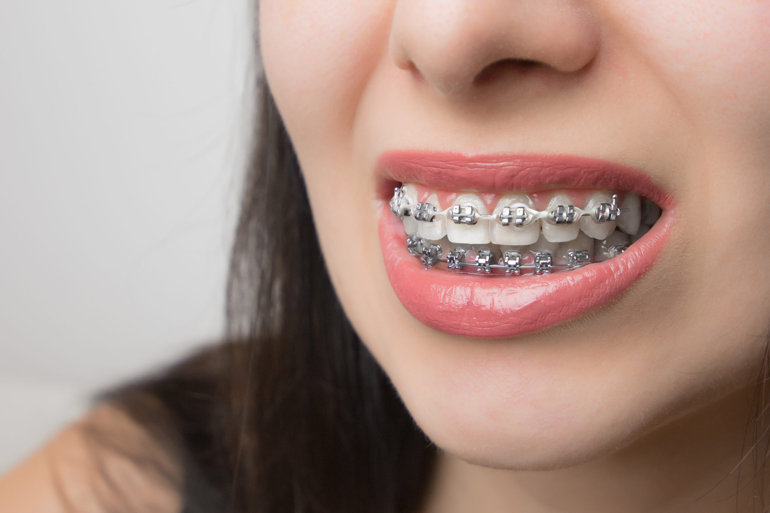 Brackets estéticos y metálicos: cómo elegir el más adecuado