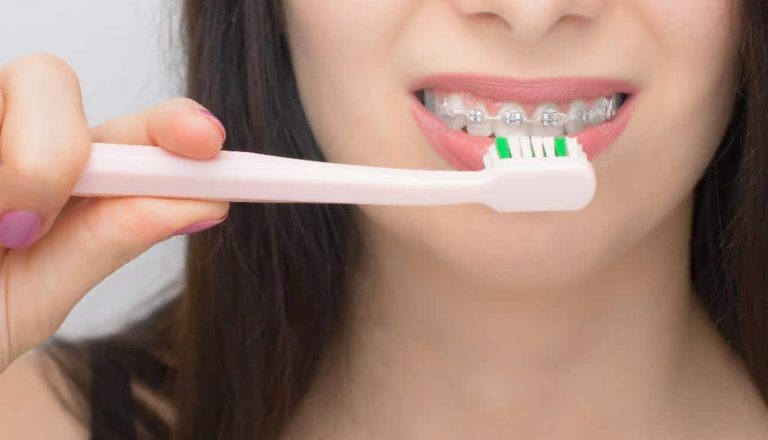 Como-limpiar-los-brackets-en-los-distintos-tipos-de-ortodoncia
