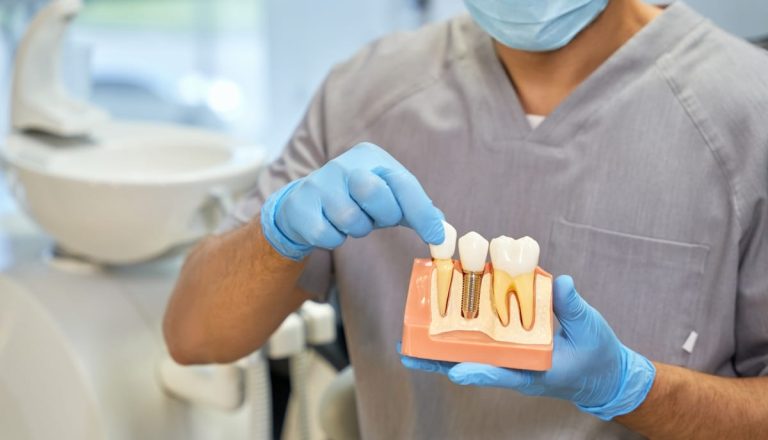Como-saber-cuantos-implantes-dentales-necesitas