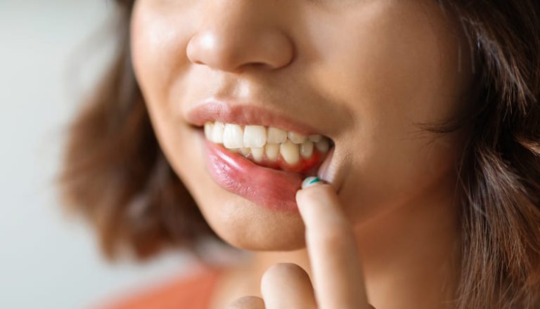diferencias entre gingivitis y periodontitis
