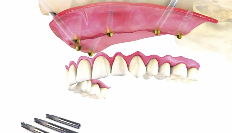 Implantes-cigomaticos