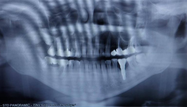 Implantes-cigomaticos.-Que-son-y-precio-1