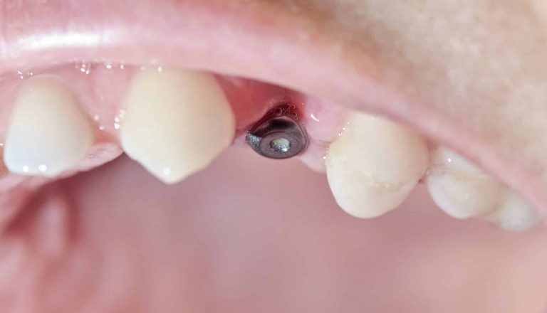 Sintomas-de-rechazo-de-un-implante-dental-scaled