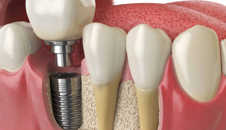 anatomy-of-healthy-teeth-and-tooth-dental-implant-2021-08-26-16-56-57-utc-scaled
