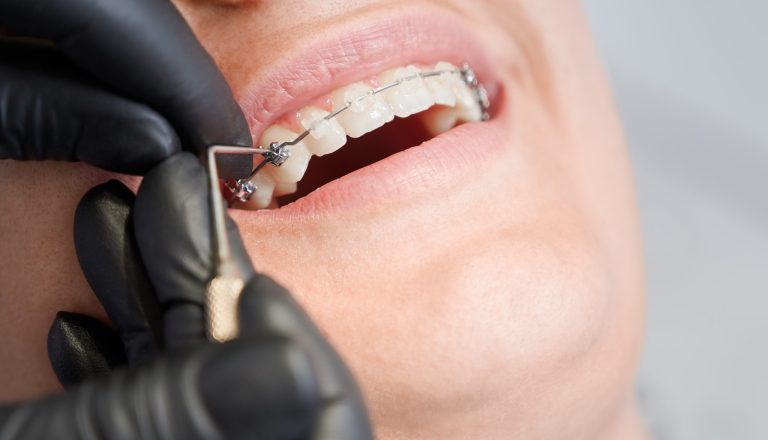 Cropped macro snapshot of teeth with ceramic and metal brackets at dentist office