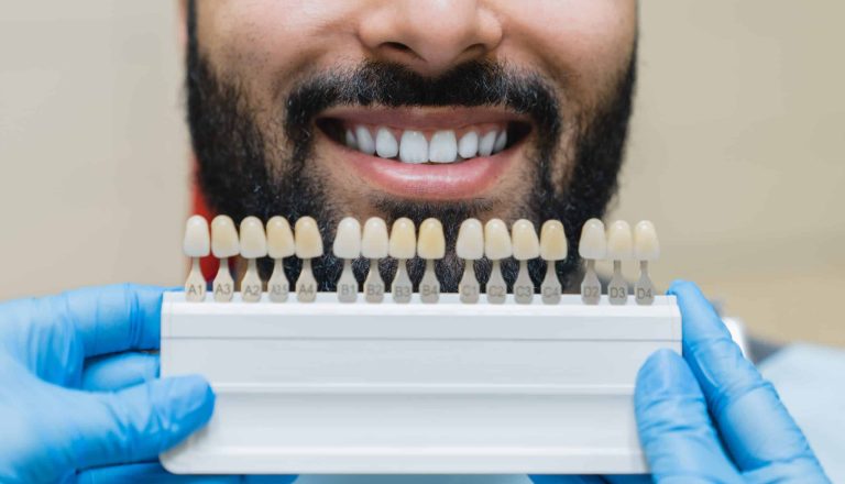 dental-care-implants-for-veneers-man-with-perfec-2021-12-09-04-31-31-utc-1-scaled