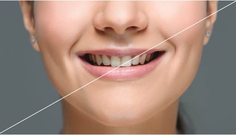 dientes-amarillos-principales-causas-soluciones-1-1