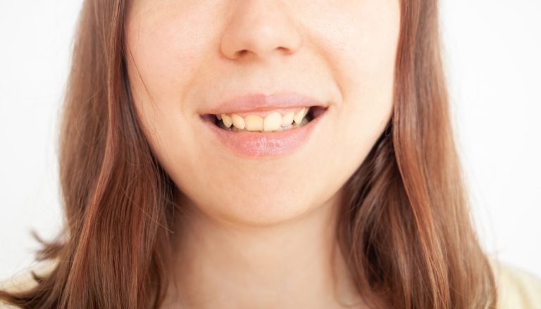 dientes-torcidos