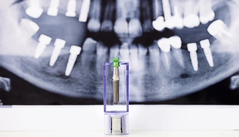 cirugia guiada implantes