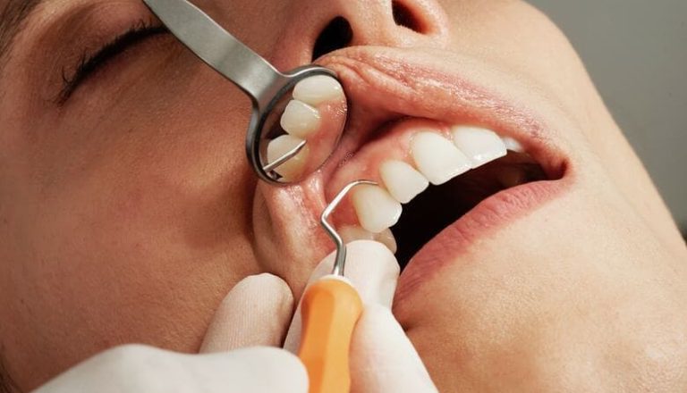 implantes-dentales-sin-cirugia