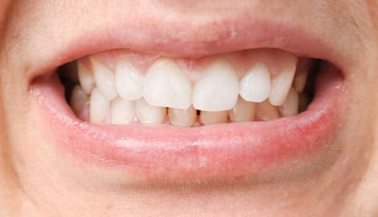 maloclusion-dental-1-1