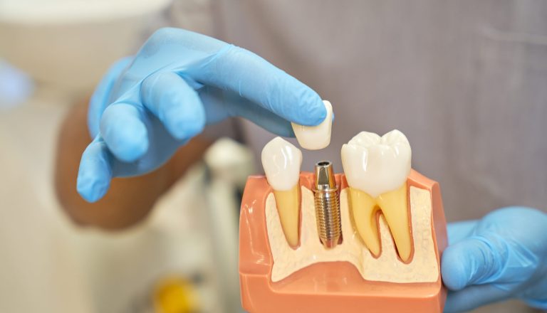 Plastic prop of teeth implant being shown by dentist