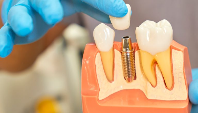 por-que-se-aflojan-los-tornillos-de-los-implantes-dentales